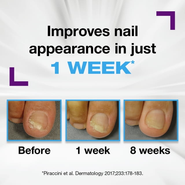 Emtrix Fungal Nail Treatment